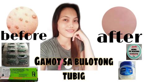 gamot sa bulutong na may nana|ᐅ Philgamot ᐅ Mga Mabisang Gamot sa Bulutong.